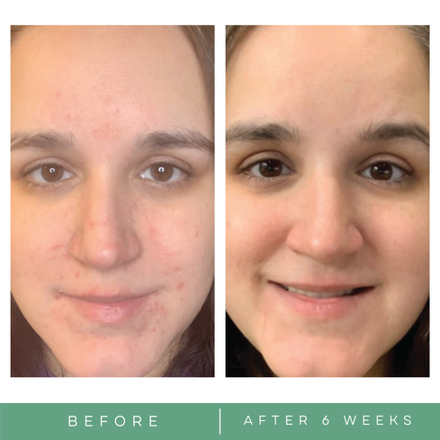 Before and after acne pictures skincare by Replenix