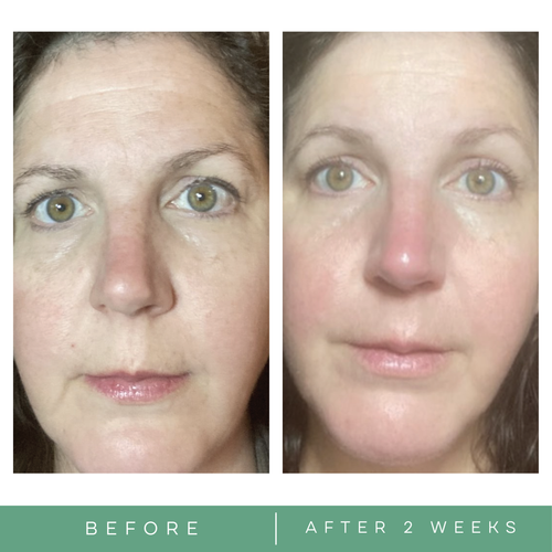 Before and after fine lines wrinkles skincare pictures. Anti wrinkle retinol cream by Replenix