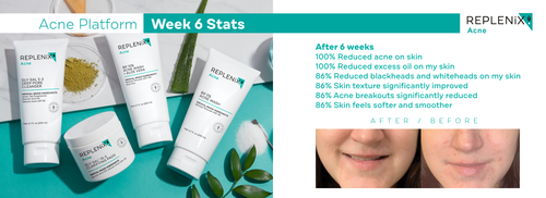 Before and after acne pictures skincare by Replenix
