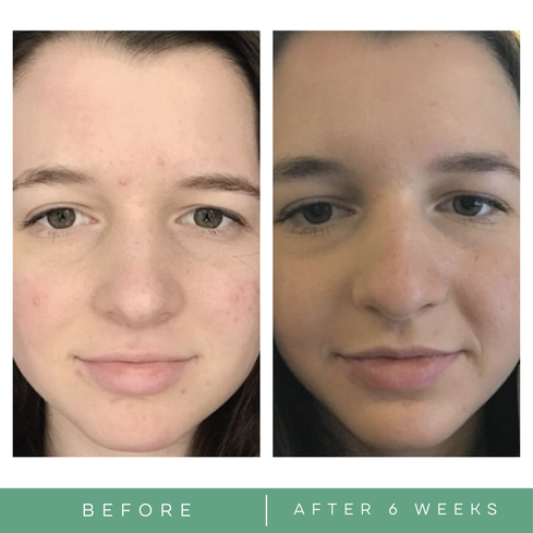 Before and after acne pictures skincare by Replenix