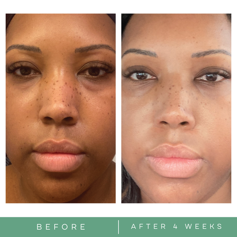 Before and after skincare pictures. Discoloration, age spots, improved skin tone Replenix