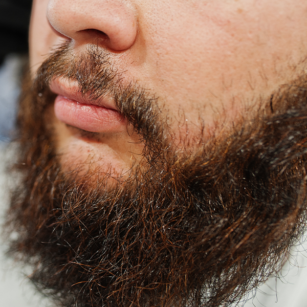 Dry beard with signs of irritation