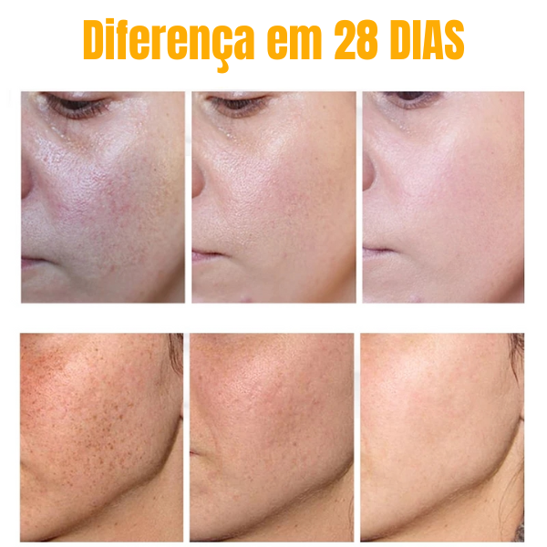 melasma