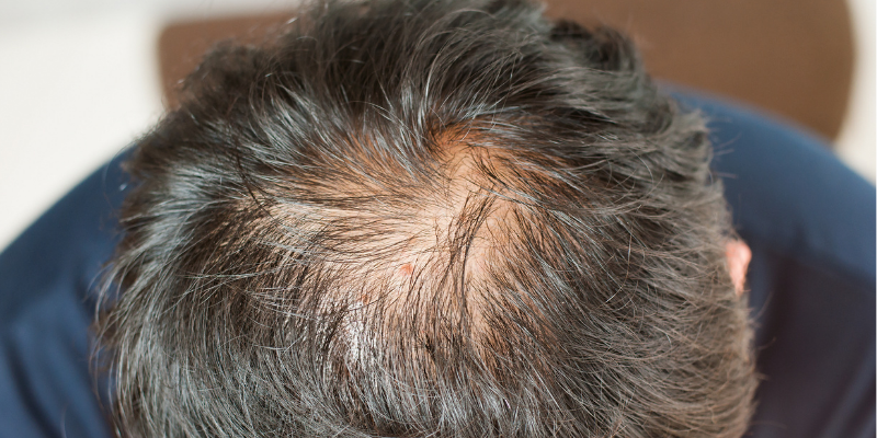 Can Vitamin Deficiency Cause Hair Loss And Can You Solve It With Hair