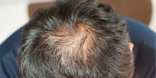 nutritional deficiencies cause hair loss