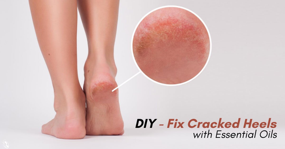 Diy Fix Cracked Heels With Essential Oils Organic Aromas