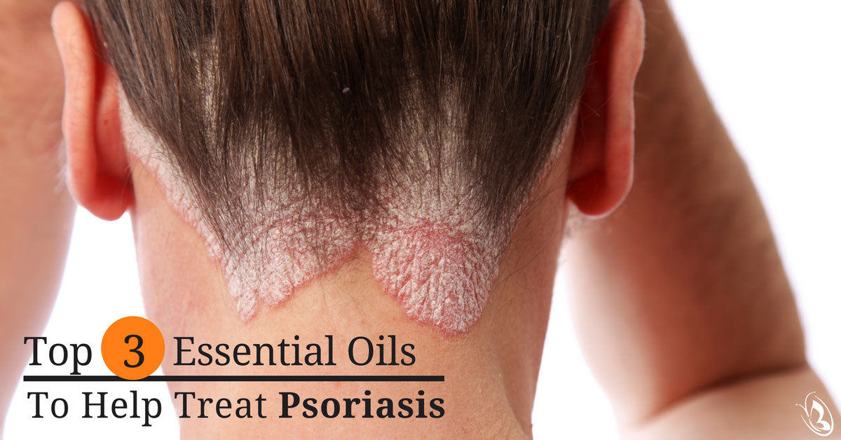 Top 3 Essential Oils To Help Treat Psoriasis Organic Aromas