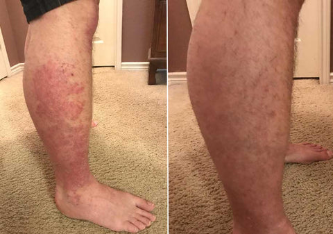 South Moon™ Instant Stop Spray for Psoriasis