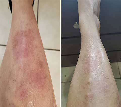 South Moon™ Instant Stop Spray for Psoriasis