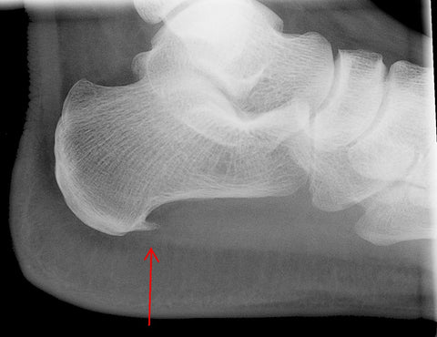 X-ray of the heel showing a small sharp bony growth at the bottom