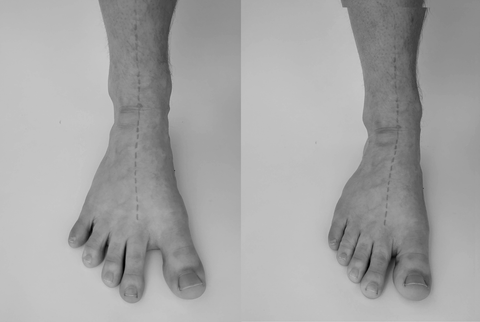 Svobodná centrovaná noha připravená pro zdravou chůzi versus noha stažená v botě