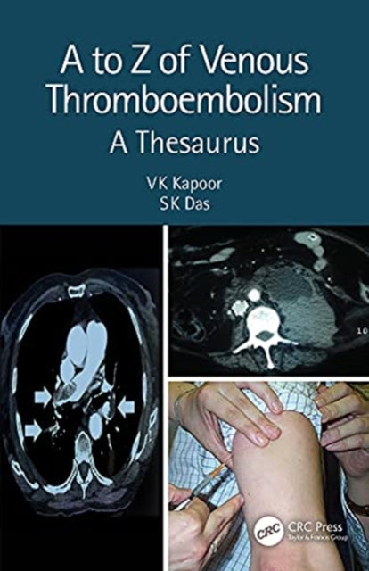 to Z of Venous Thromboembolism: A Thesaurus