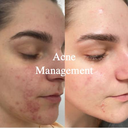 Acne Management 