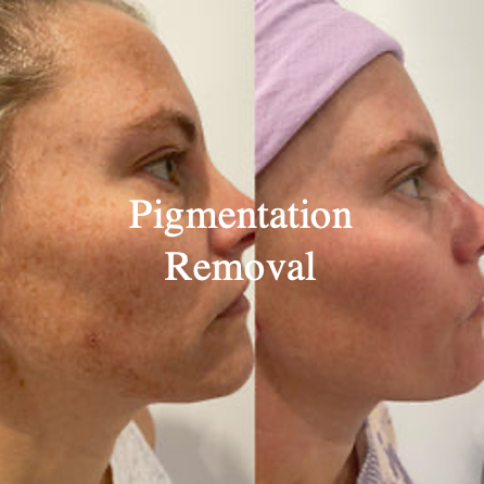 Pigmentation Removal