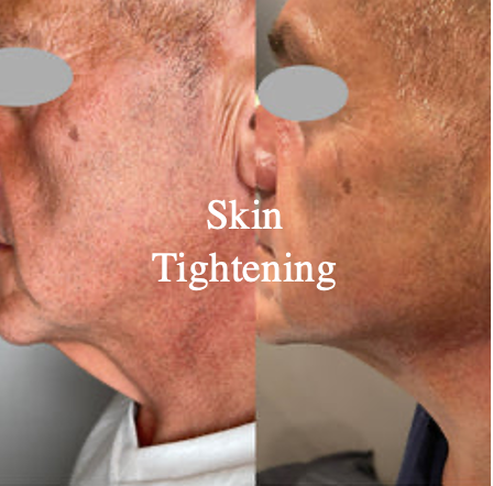 Skin Tightening