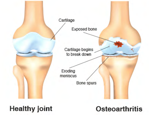 JointEase™ Portable Ultrasonic Arthritis Relief Device