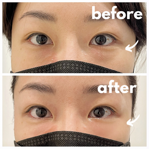 Bojin Eye Rejuvenation Treatment – BBFACE SG
