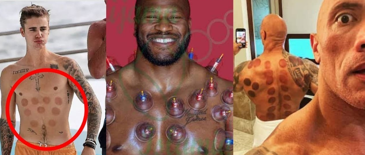 Celebs | Cupping Therapy | CausalityCare.com