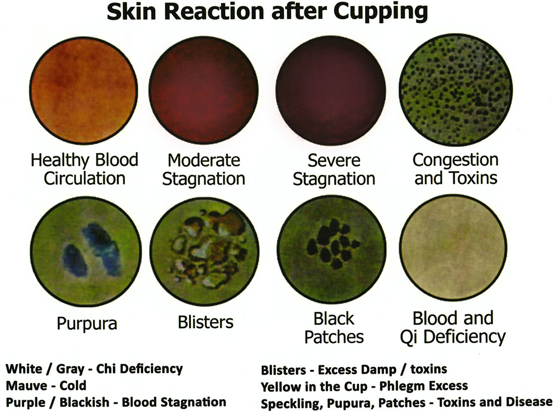 Results / Reaction of Cupping Therapy | CausalityCare.com