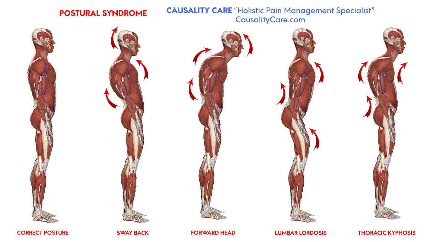 Postural Syndrome | CausalityCare.com