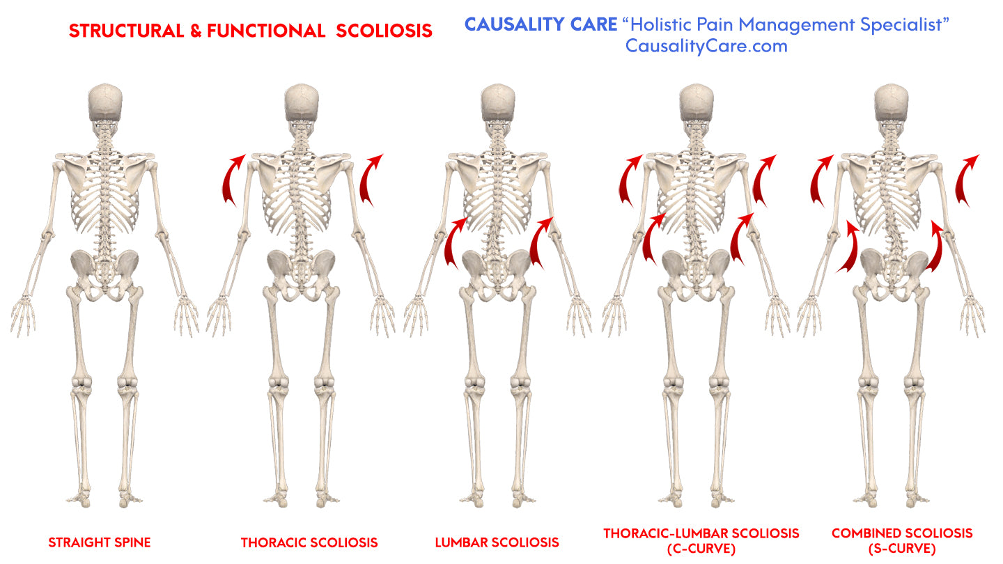 Types of Scoliosis and Treatment by CausalityCare.com
