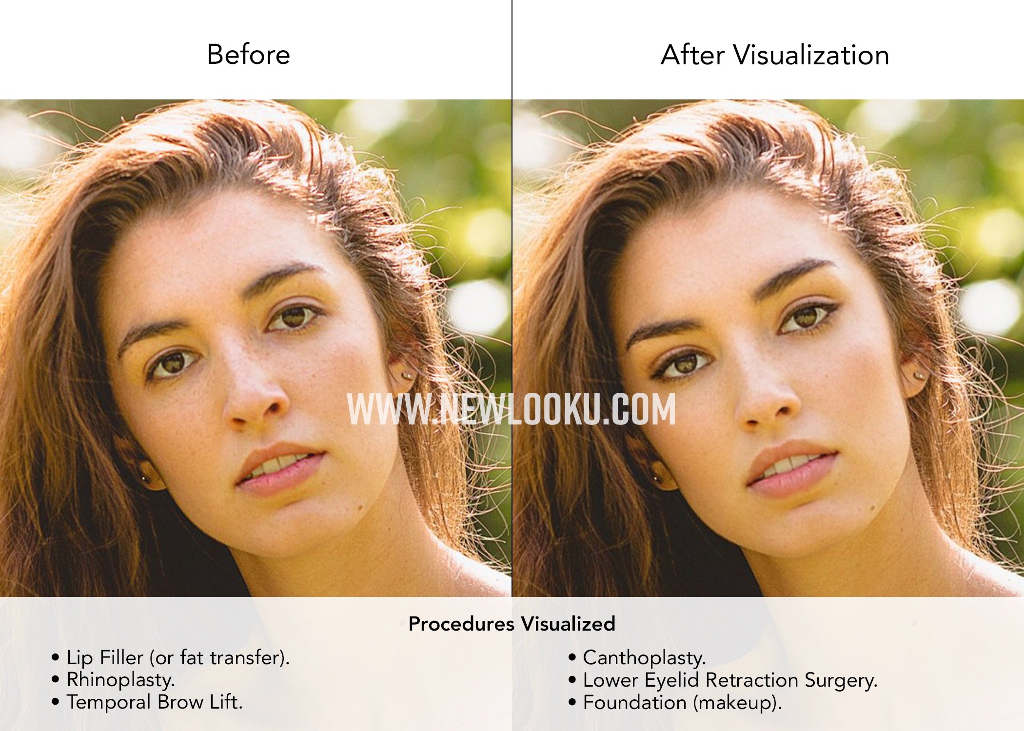 Female Plastic Surgery Visualization Before and After: Lip Filler (or fat transfer). Rhinoplasty. Temporal Brow Lift and Canthoplasty. Lower Eyelid Retraction Surgery. 