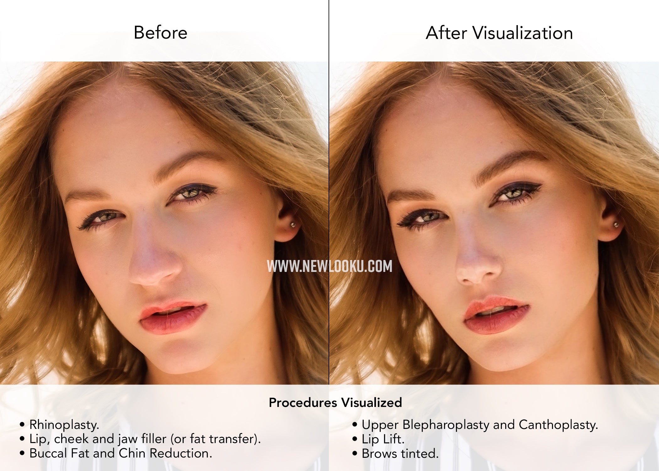 Female Plastic Surgery Visualization Before and After: Rhinoplasty. Lip, Cheek and Jaw Filler (or Fat Transfer). Buccal Fat Reduction. Chin Reduction. Upper Blepharoplasty. Canthoplasty. Lip Lift.