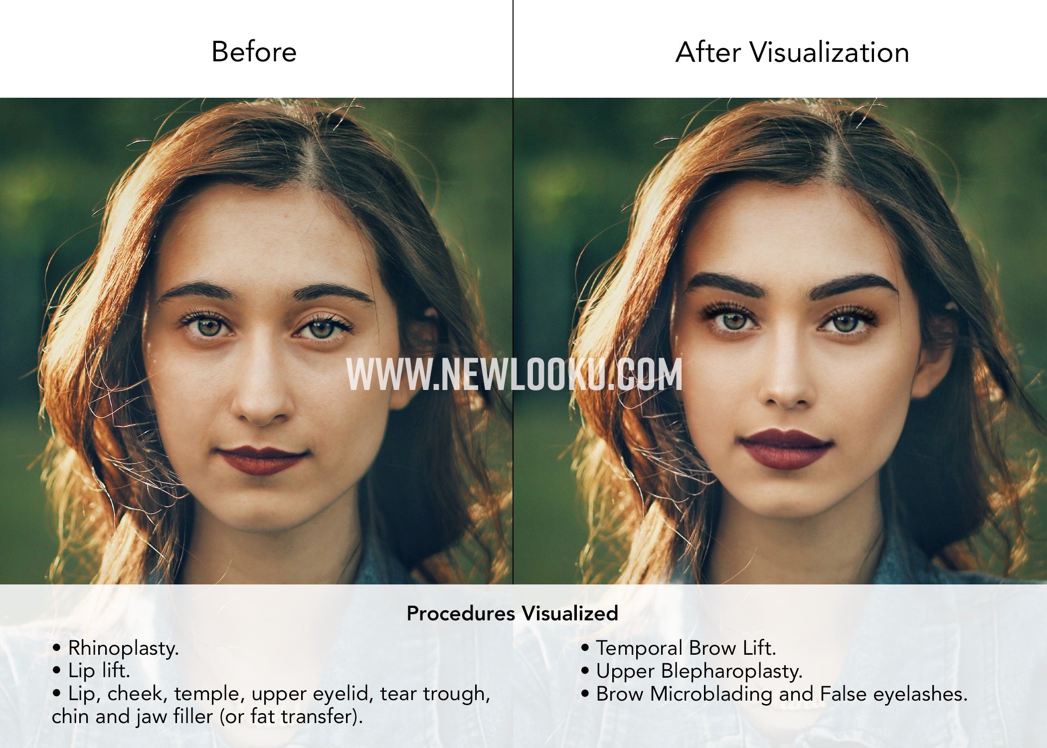 Female Plastic Surgery Visualization Before and After: Rhinoplasty. Lip lift. Lip, cheek, temple, upper eyelid, tear trough, chin and jaw filler (or fat transfer). Temporal Brow Lift. Upper Blepharoplasty. Brow Microblading and False eyelashes. 