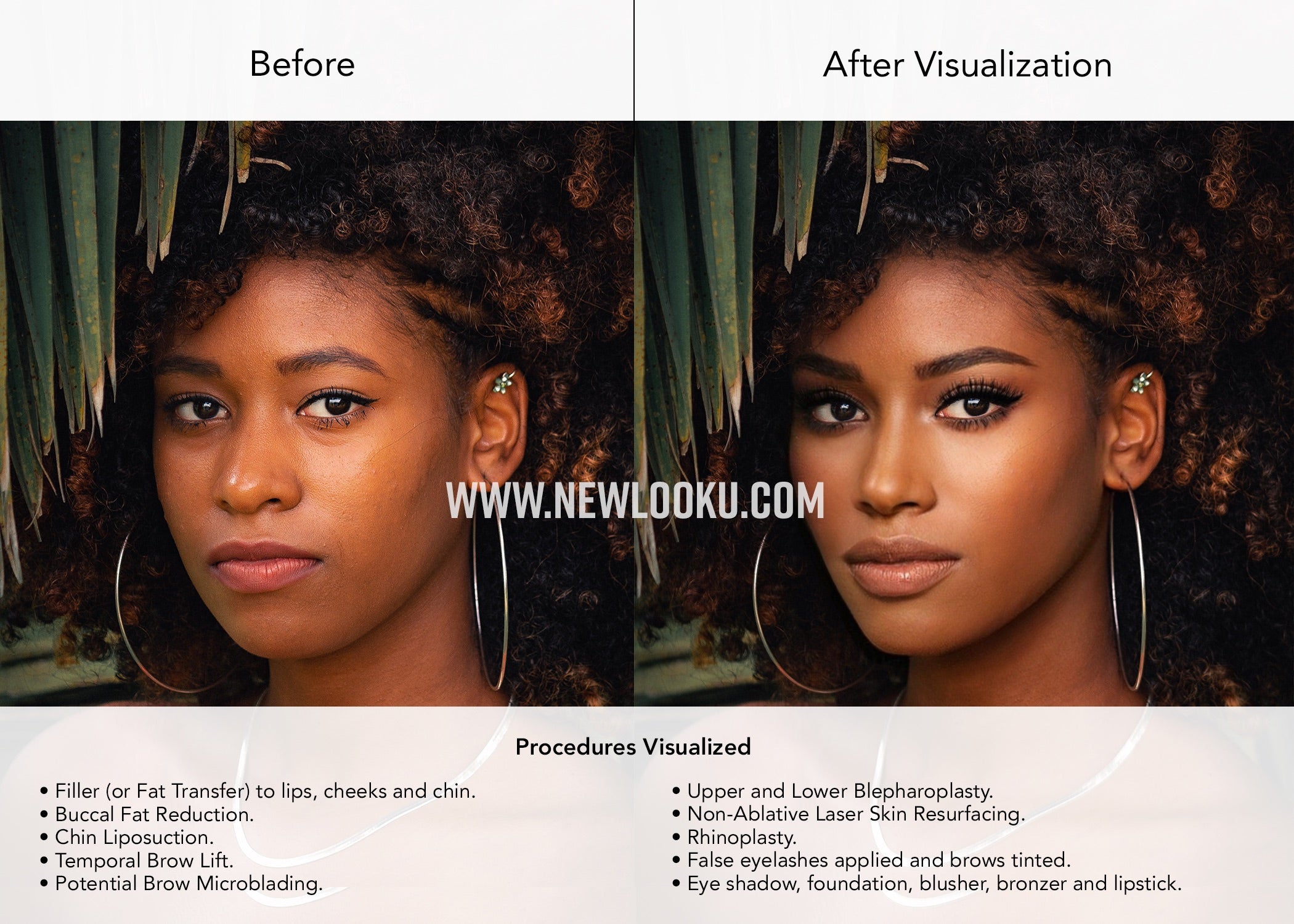 Black Female Plastic Surgery Visualization Before and After: Filler (or Fat Transfer) to lips, cheeks and chin. Buccal Fat Reduction. Chin Liposuction. Temporal Brow Lift. Upper and Lower Blepharoplastv. Non-Ablative Laser Skin Resurfacing. Rhinoplasty.