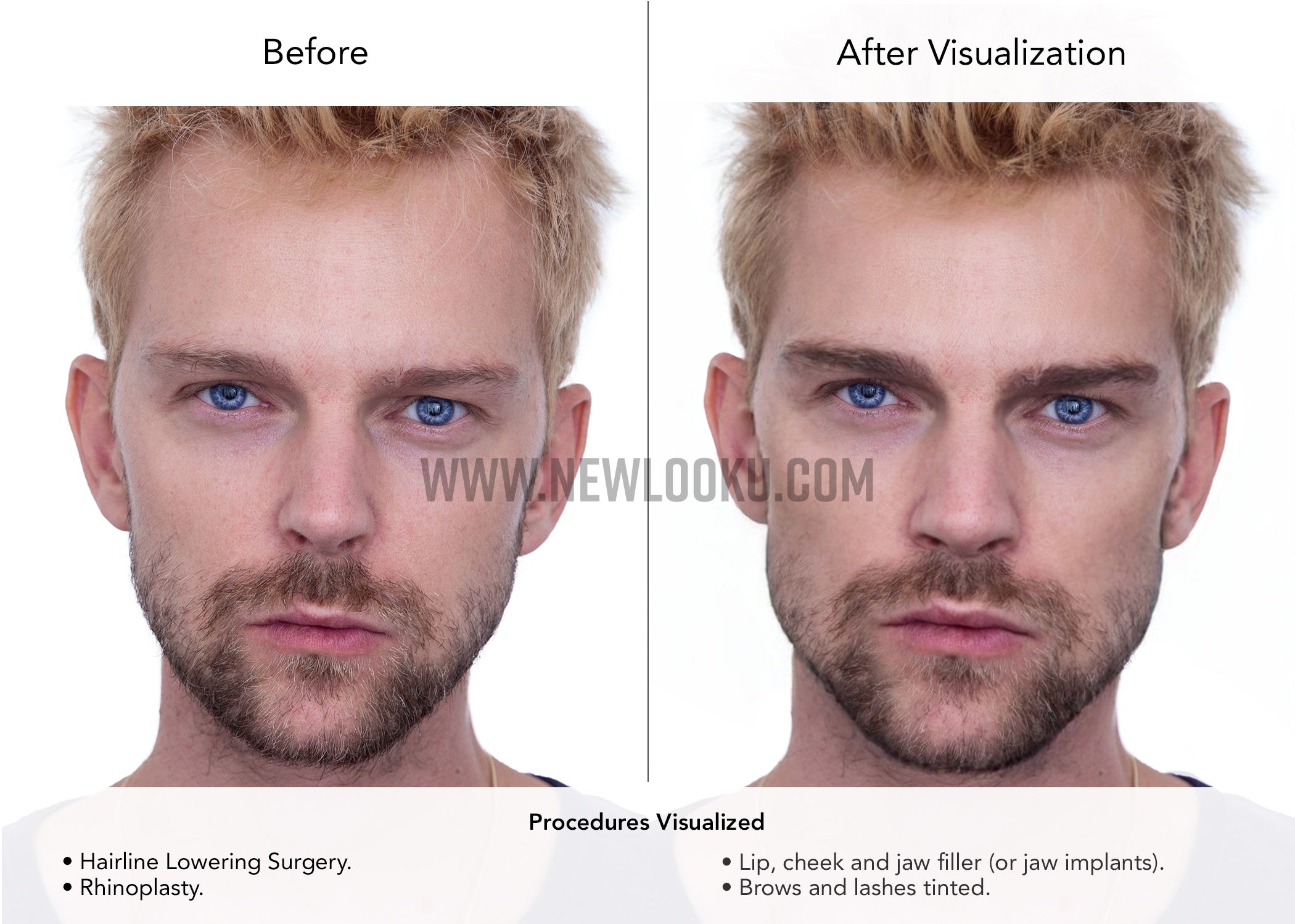 Male Plastic Surgery Visualization Before and After: Hairline Lowering Surgery. Rhinoplasty. Jaw implants (or possibly jaw filler). Lip and cheek filler (or fat transfer).