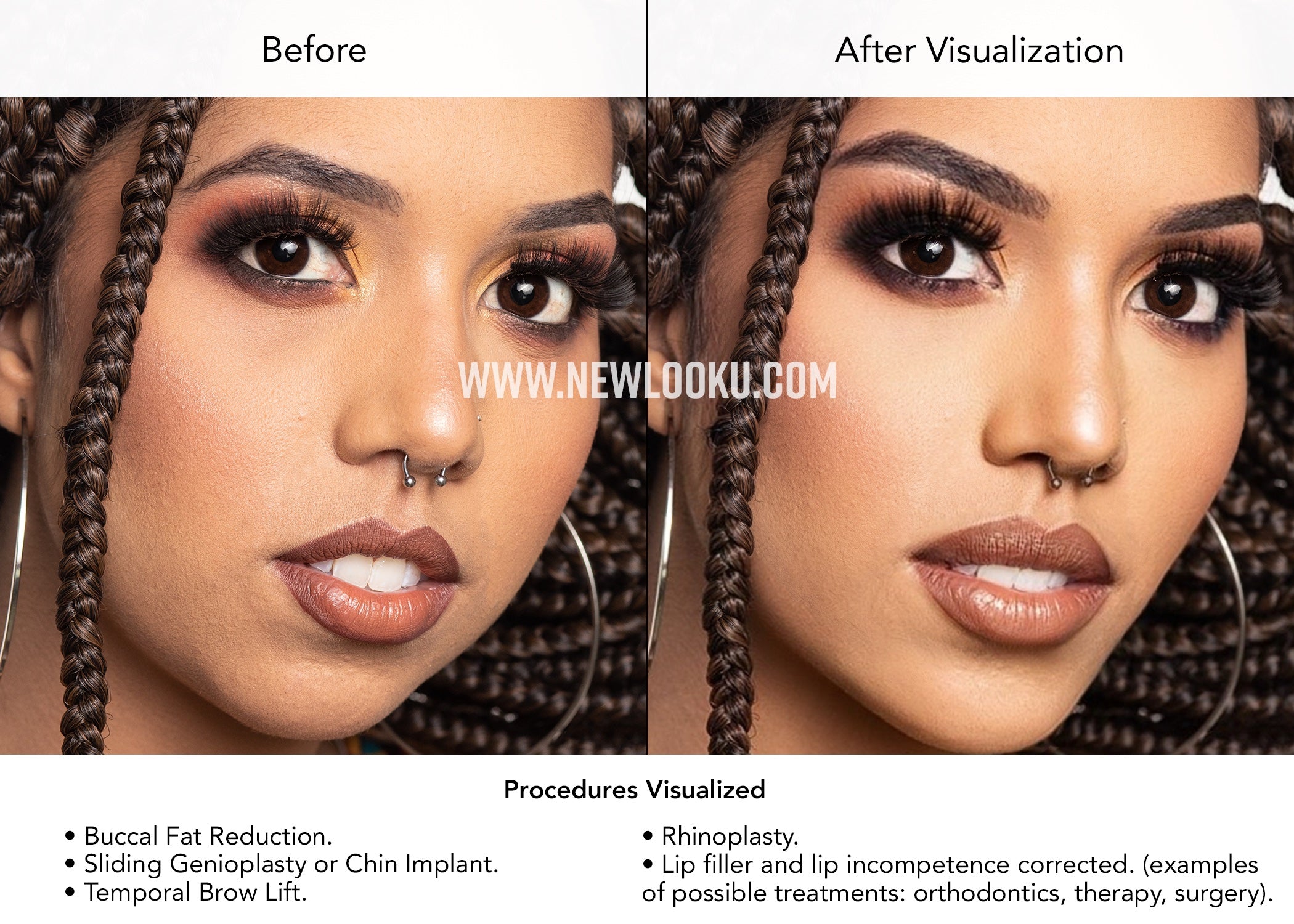 Black Female Plastic Surgery Visualization Before and After: Buccal Fat Reduction. Sliding Genioplasty or Chin Implant. Temporal Brow Lift. Lip incompetence corrected. Rhinoplasty. Lip filler (or fat transfer).