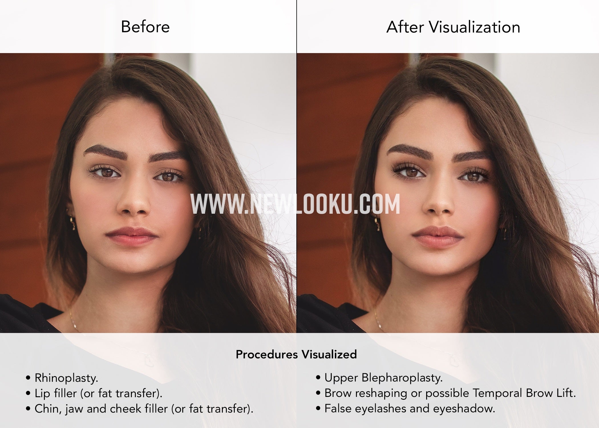 Female Plastic Surgery Visualization Before and After: Rhinoplasty. Lip, chin, jaw and cheek filler (or fat transfer). Upper Blepharoplasty. Brow reshaping or possible Temporal Brow Lift.