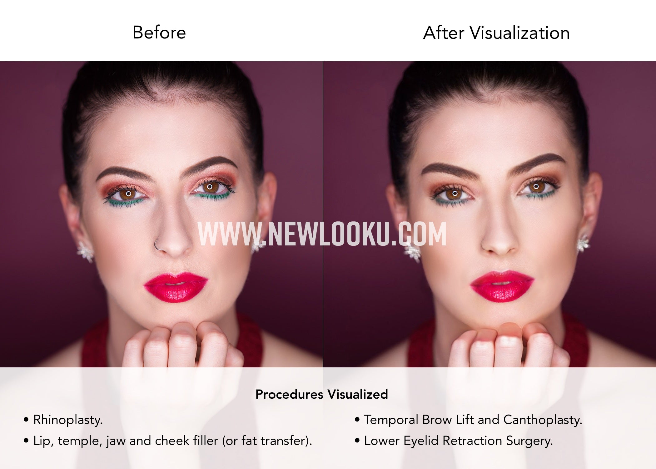 Female Plastic Surgery Visualization Before and After: Rhinoplasty. Temporal Brow Lift and Canthoplasty. Lower Eyelid Retraction Surgery. Lip, temple, jaw and cheek filler (or fat transfer).