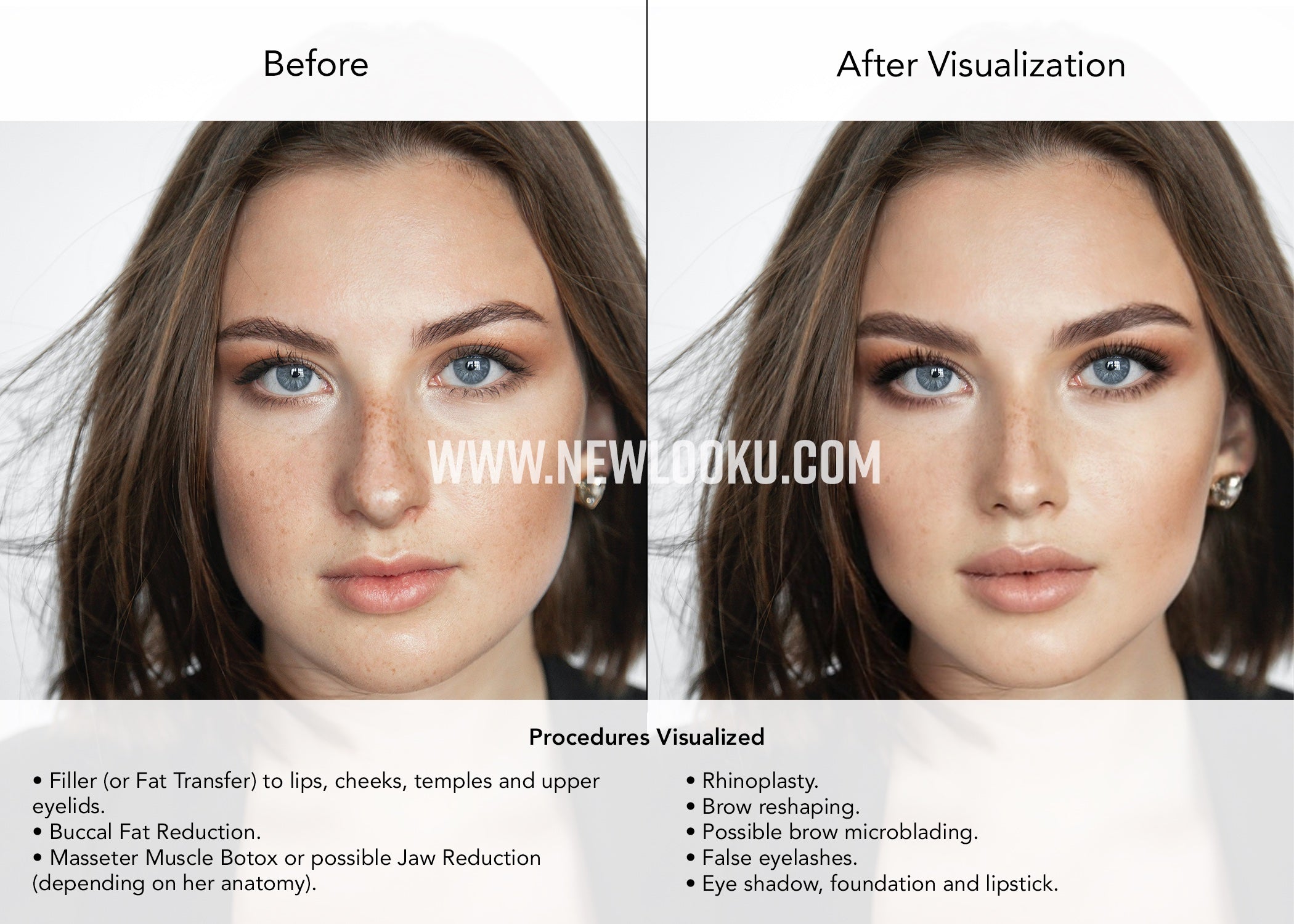 Female Plastic Surgery Visualization Before and After: Filler (or Fat Transfer) to lips, cheeks, temples and upper eyelids. Buccal Fat Reduction. Masseter Muscle Botox or possible Jaw Reduction. Rhinoplasty.