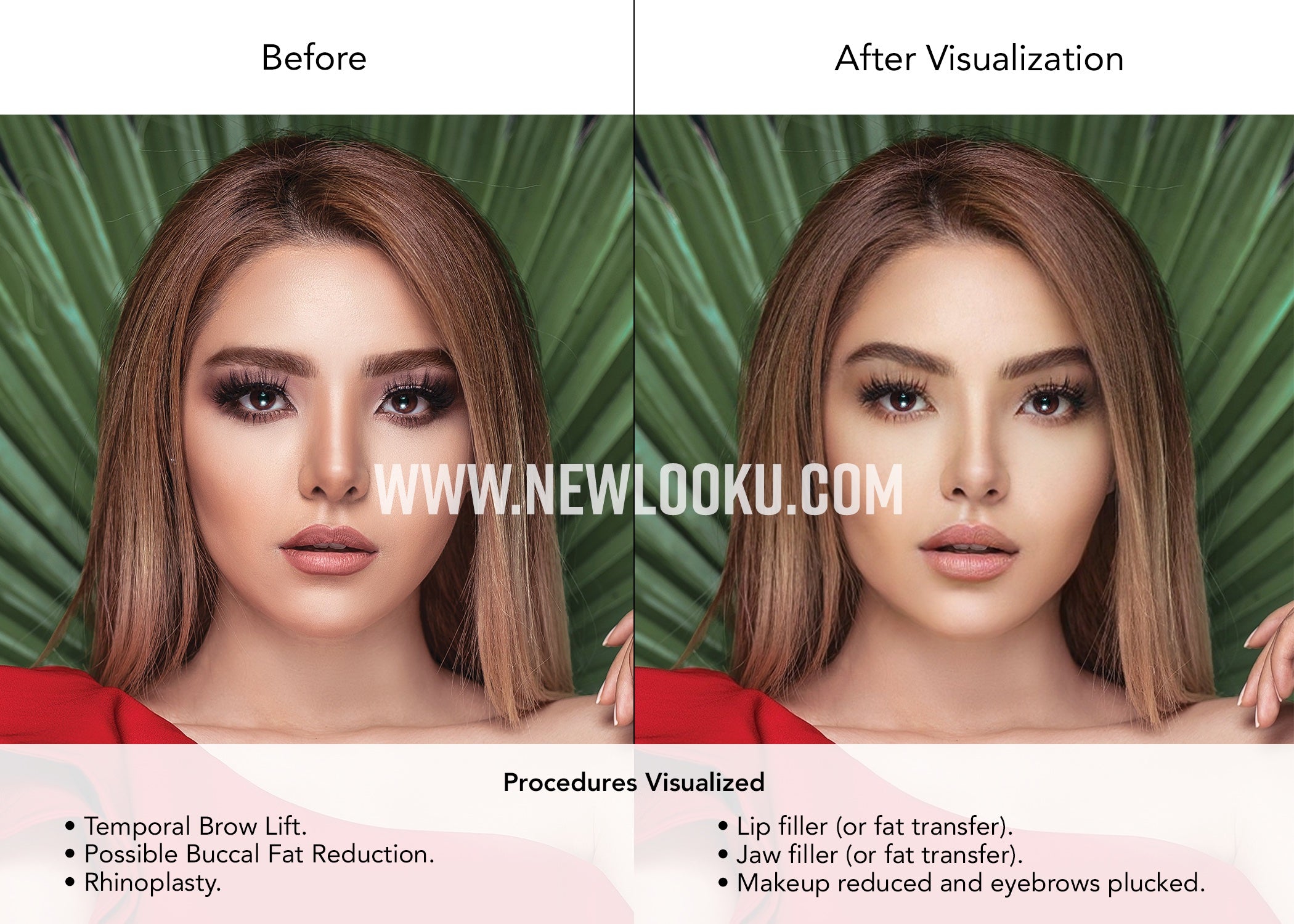 Asian Female Plastic Surgery Visualization Before and After: Temporal Brow Lift. Buccal fat reduction. Rhinoplasty. Lip and jaw filler (or fat transfer). 