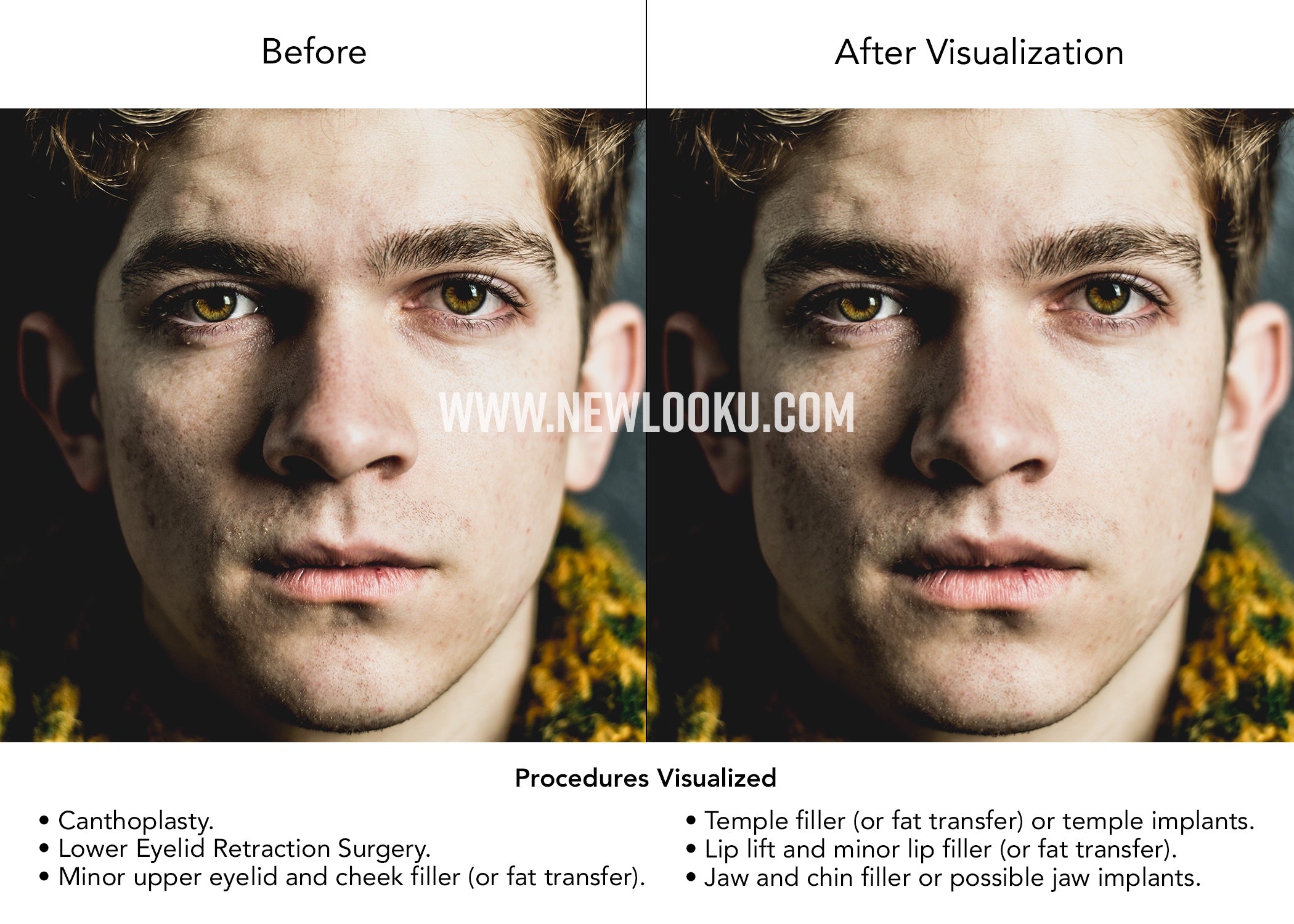 Male Plastic Surgery Visualization Before and After: Canthoplasty. Lower Eyelid Retraction Surgery. Minor upper eyelid and cheek filler (or fat transfer). Temple filler (or fat transfer) or possible temple implants. Lip lift with possible lip filler (or fat transfer). Jaw and chin filler or possible jaw implants.
