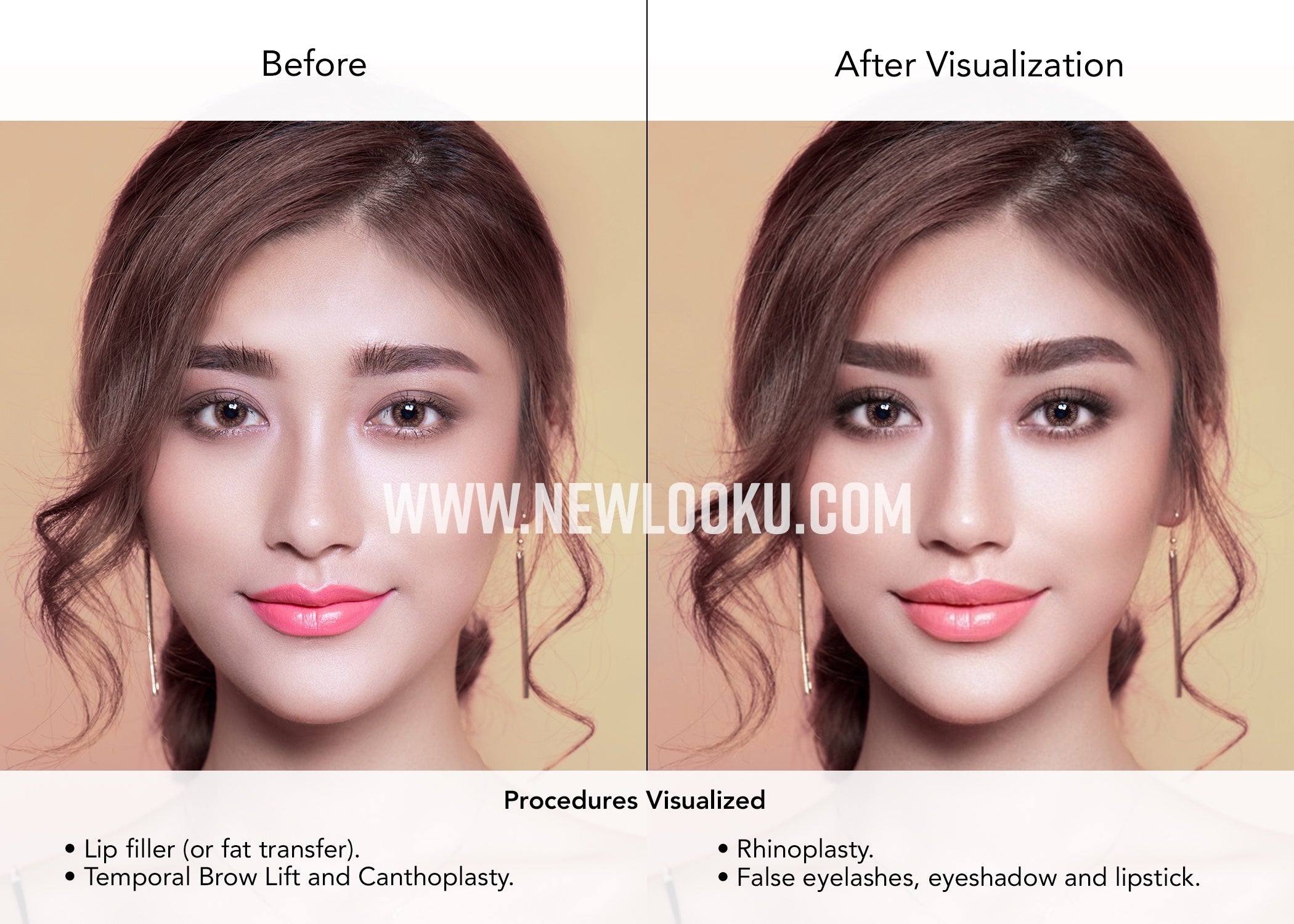 Asian Female Plastic Surgery Visualization Before and After:Lip Filler (or fat transfer). Temporal Brow Lift and Canthoplasty. Rhinoplasty. 
