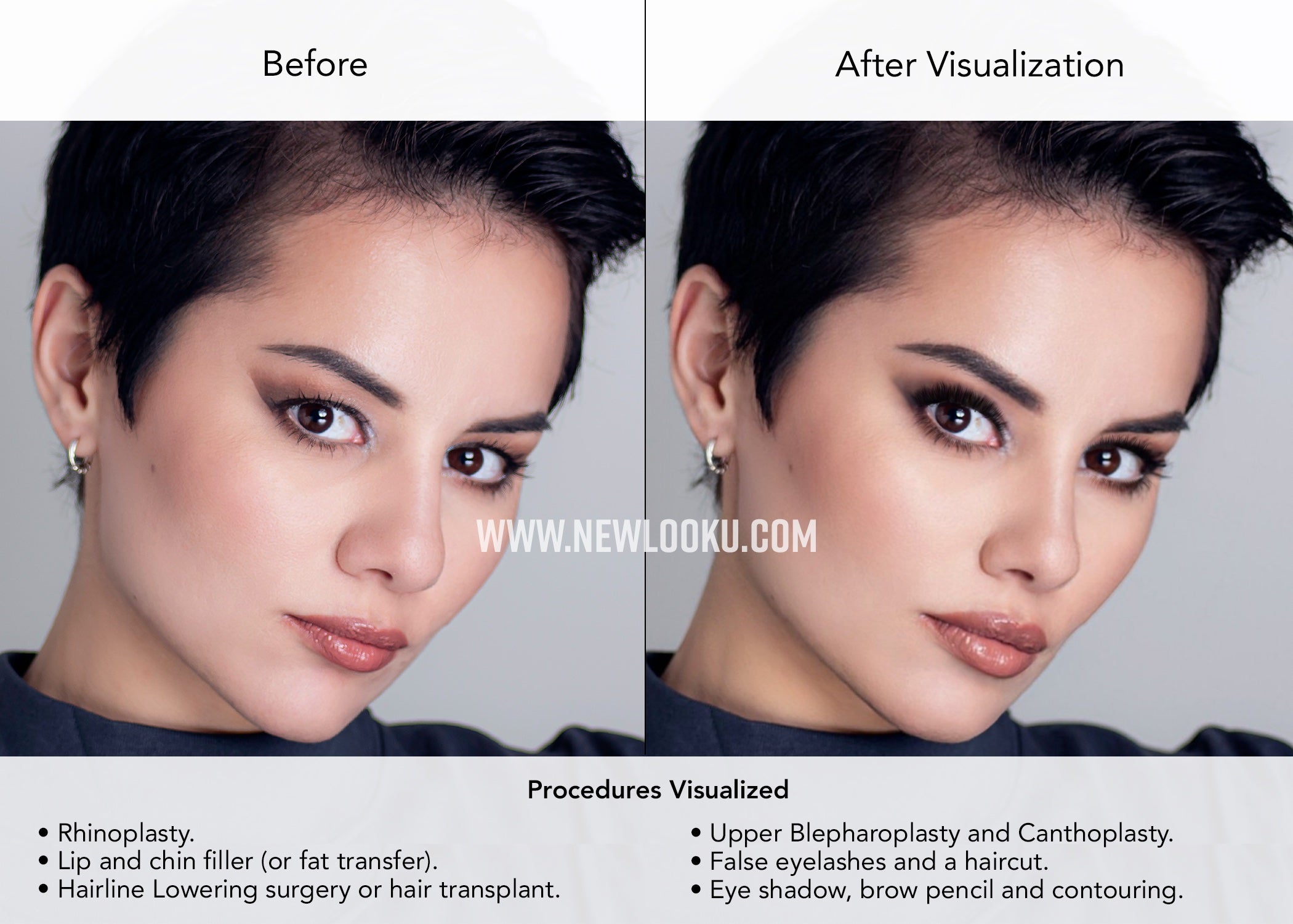 Female Plastic Surgery Visualization Before and After: Rhinoplasty. Lip and chin filler (or fat transfer). Hairline Lowering surgery or hair transplant. Upper Blepharoplasty and Canthoplasty.