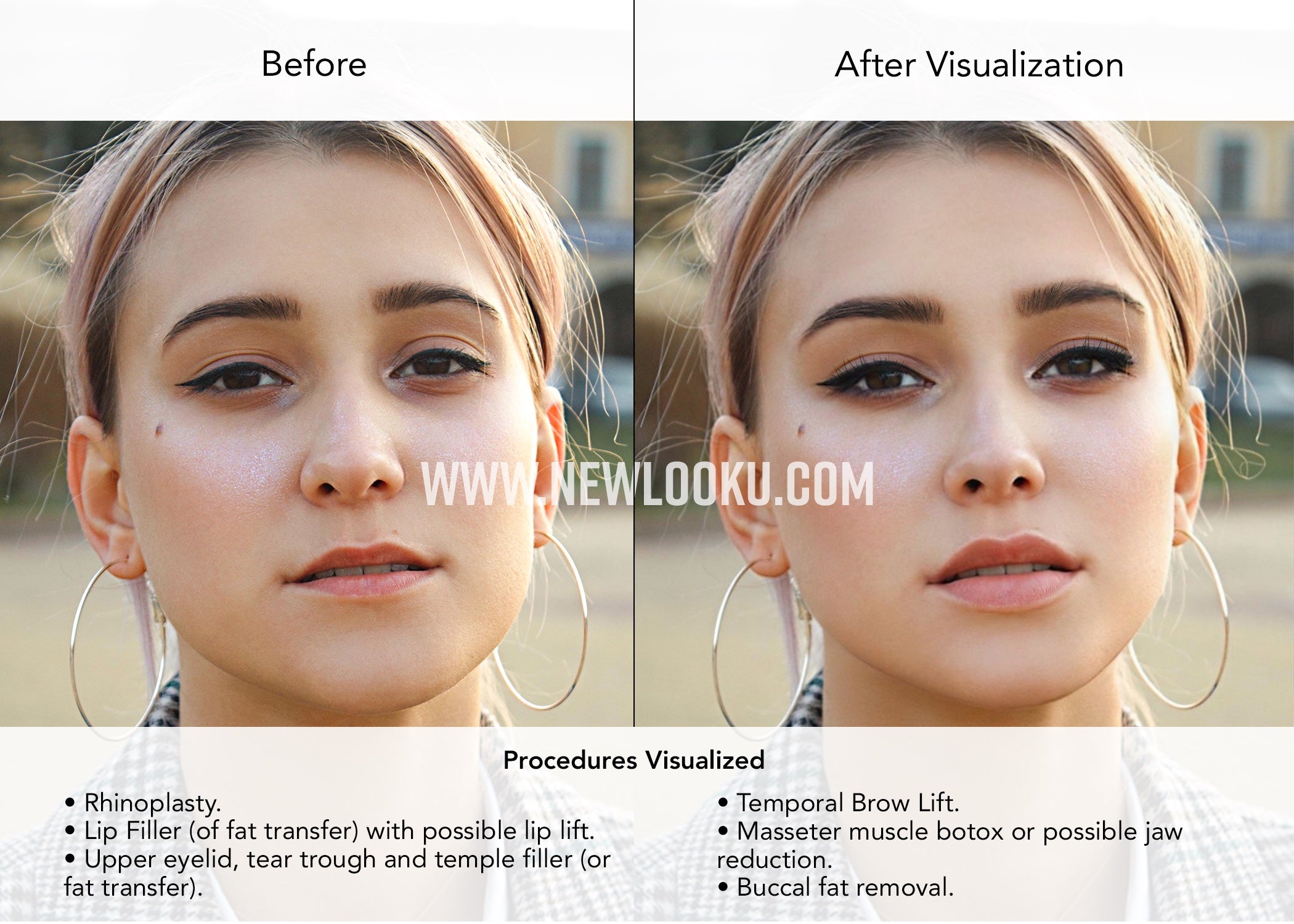 Female Plastic Surgery Visualization Before and After: Rhinoplasty. Lip Filler (of fat transfer) with possible lip lift. Upper eyelid, tear trough and temple filler (or fat transfer). Temporal Brow Lift. Masseter muscle botox or possible jaw reduction. Buccal fat removal.