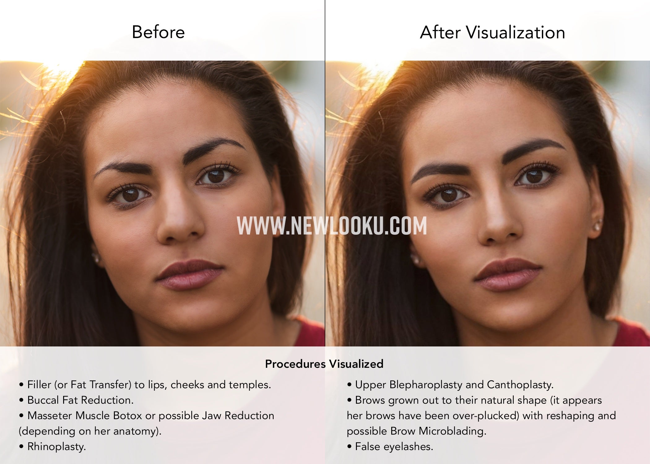 Female Plastic Surgery Visualization Before and After: Rhinoplasty, Lip Filler, Brow Reshaping, Buccal Fat Reduction, Jaw Filler, Canthoplasty and Upper Blepharoplasty. Brows reshaped with possible Brow Microblading.