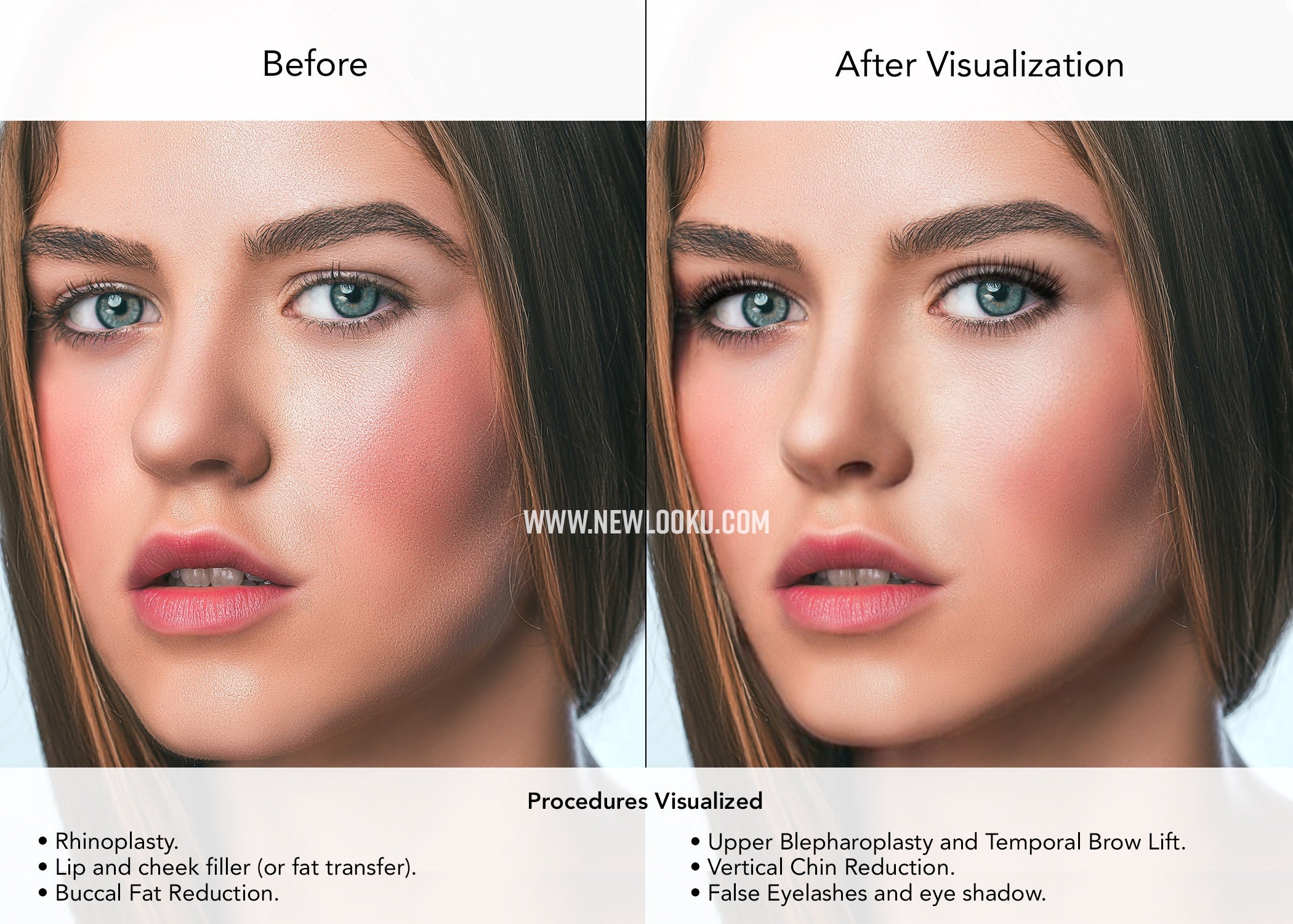 Female Plastic Surgery Visualization Before and After: Rhinoplasty. Lip and cheek filler (or fat transfer). Buccal Fat Reduction. Upper Blepharoplasty and Temporal Brow Lift. Vertical Chin Reduction.