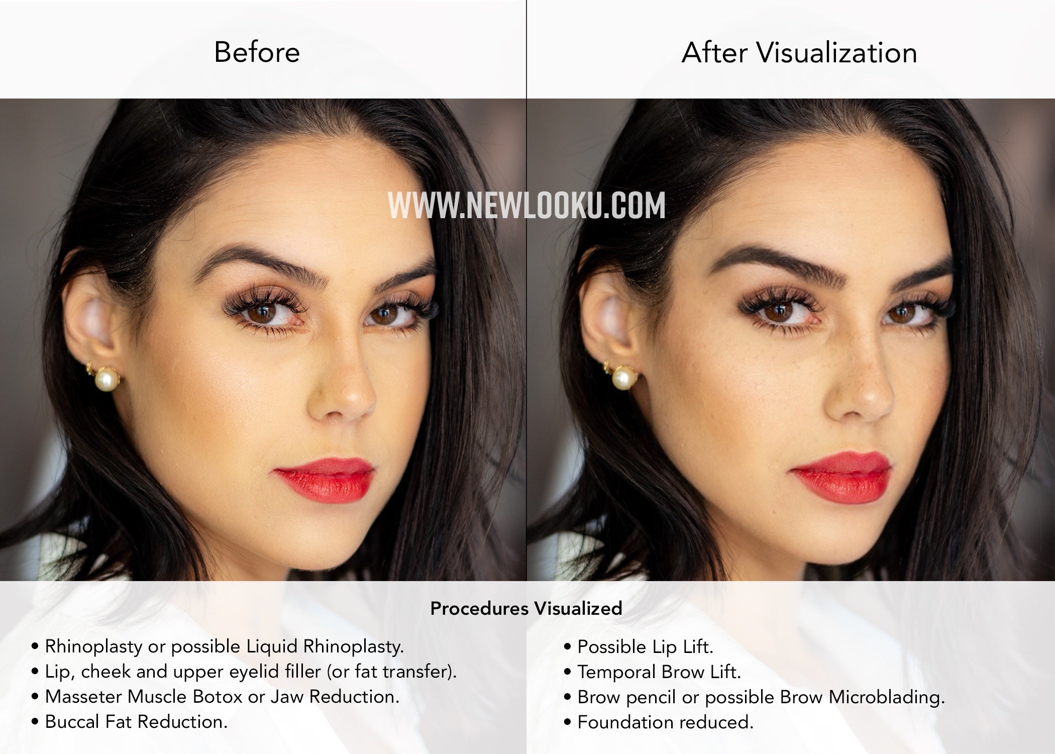 Female Plastic Surgery Visualization Before and After: Rhinoplasty or possible Liquid Rhinoplasty. Lip, cheek and upper evelid filler (or fat transfer). Masseter Muscle Botox or Jaw Reduction. Buccal Fat Reduction. Possible Lip Lift. Temporal Brow Lift.