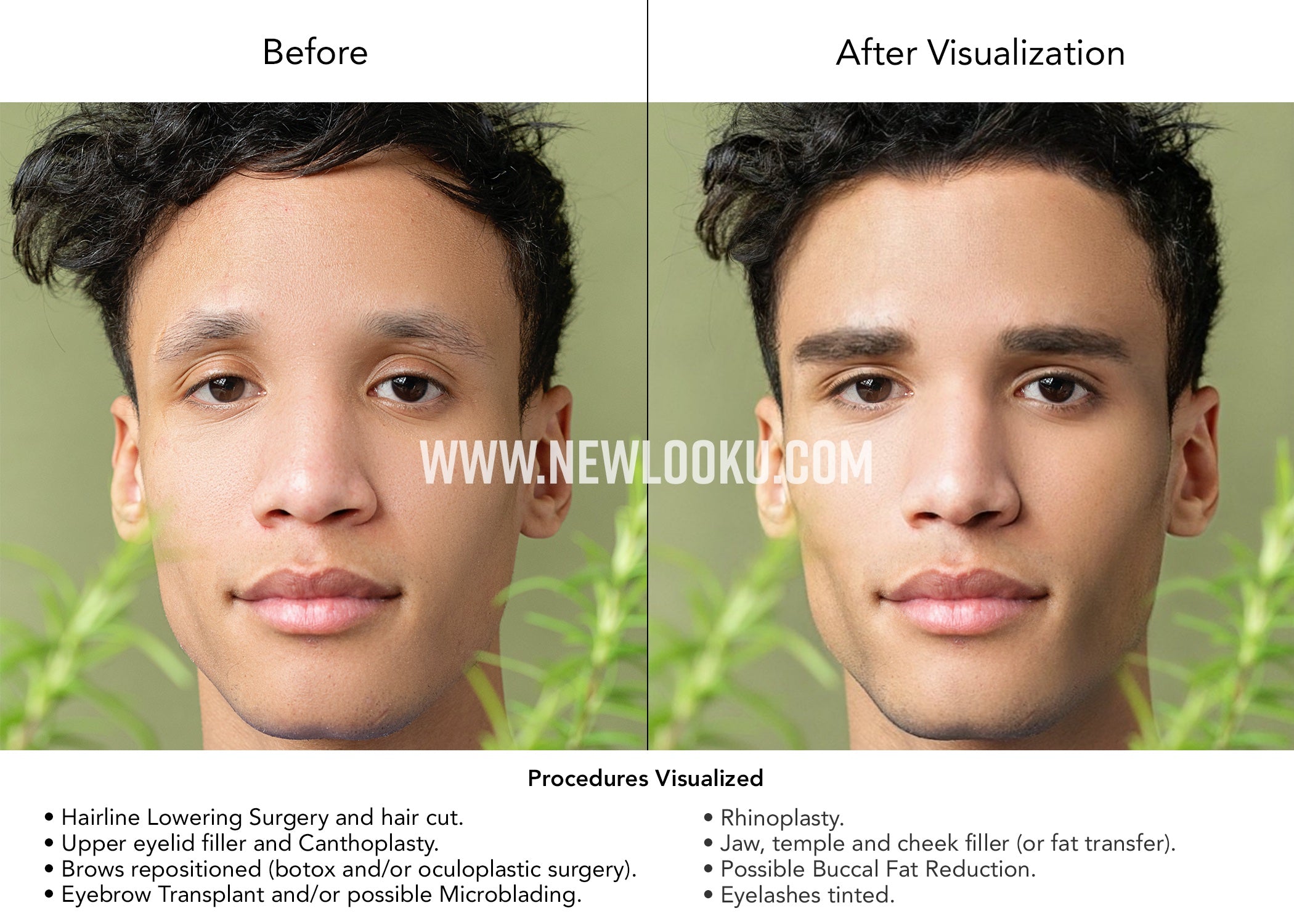 Male Plastic Surgery Visualization Before and After: Hairline Lowering Surgery and hair cut. Upper eyelid filler and Canthoplasty. Brows repositioned (using botox and/or surgical techniques). Eyebrow Transplant with possible Microblading. Rhinoplasty. Jaw, temple and cheek filler (or fat transfer). Possible Buccal Fat Reduction.