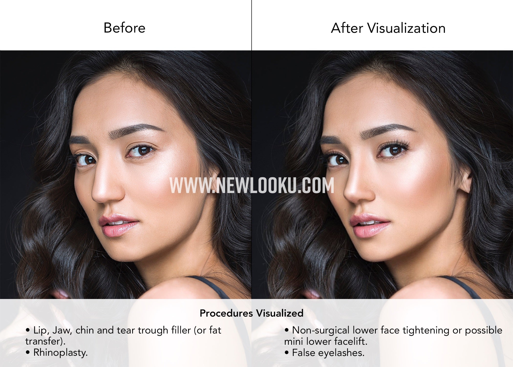Female Plastic Surgery Visualization Before and After: Rhinoplasty. Lip, Jaw, chin and tear trough filler (or fat transfer). Non-surgical lower face tightening or possible mini lower facelift.