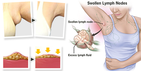 LUMPFree Herbal LipomaRemoval Cream