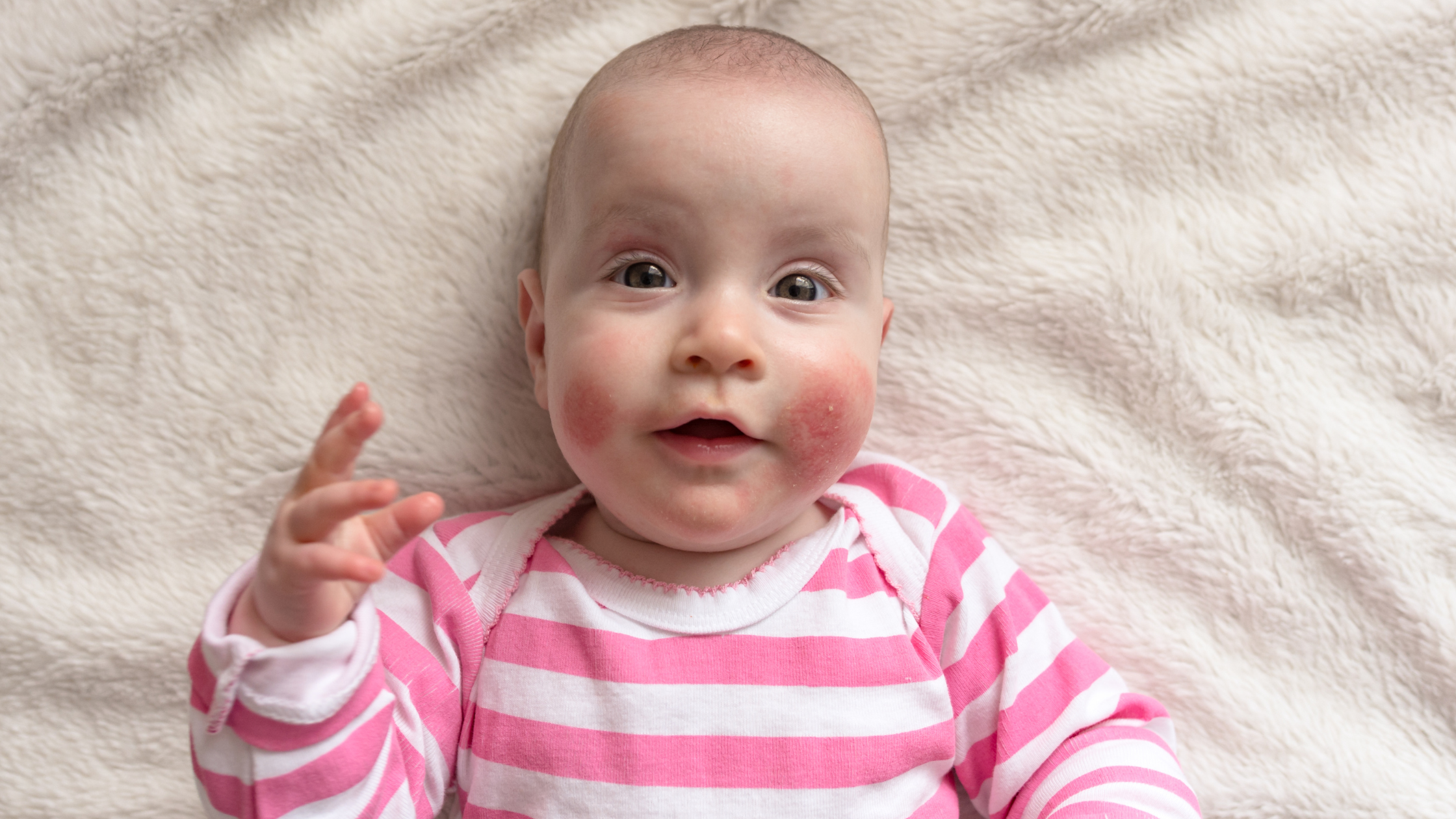 Baby with rash on cheeks 