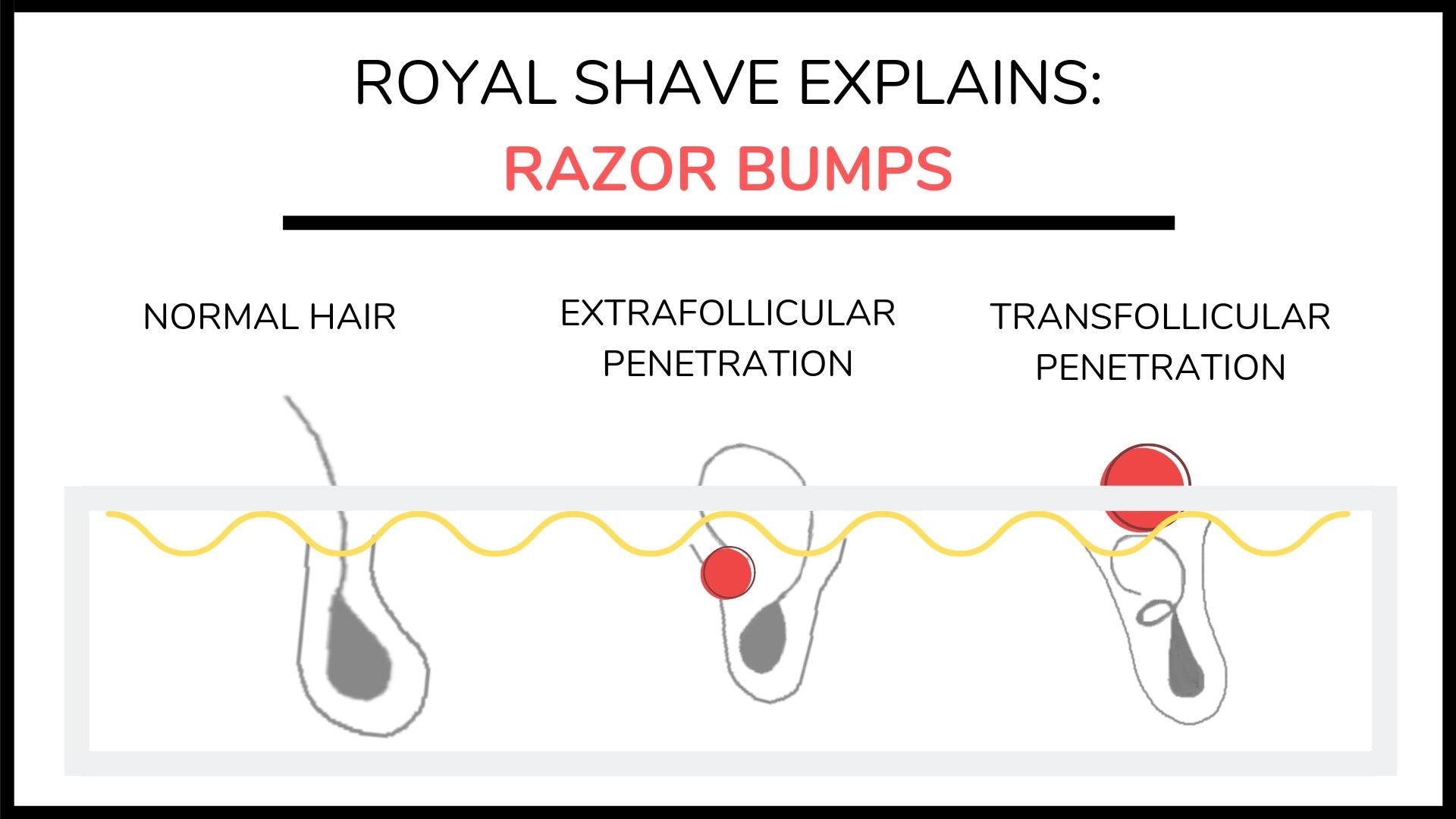 Ryal Shave explains razor bumps