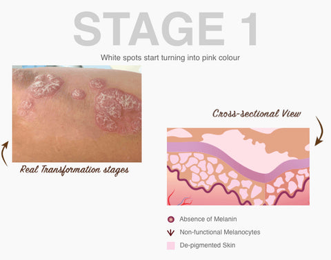 BIORAMAX PsoriaRescue Treatment Spray