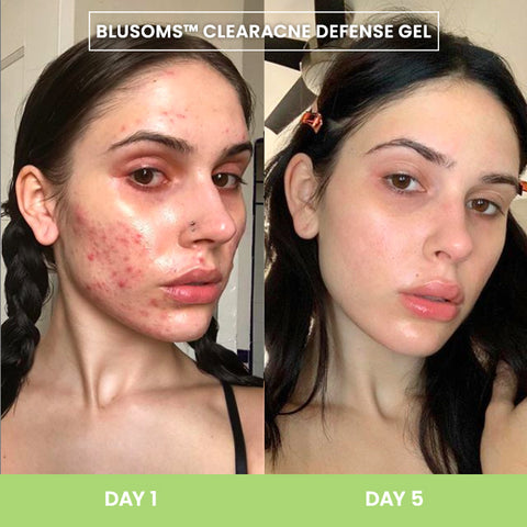 Blusoms™ ClearAcne Defense Gel