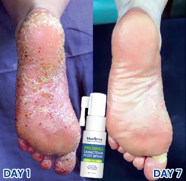 Blusoms™ PROBRIO Debacteria Foot Spray